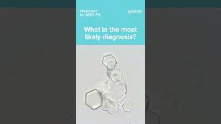 The urinalysis of a patient with excruciating flank pain and occasional blood in his urine [upl. by Okwu]