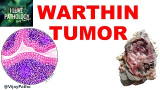 WARTHIN TUMOR  Etiopathogenesis Clinical features Gross and Microscopic features [upl. by Maximilianus]