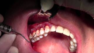 Alloderm Gingival Grafting 36 Sites Graft Suturing [upl. by Tempest]