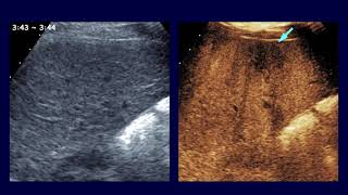 A missed scirrhous HCC found with advanced gastric cancer issues of scan delay amp CT vs MRI [upl. by Ane]