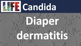 Candida diaper dermatitis part 13 [upl. by Naitsirt]