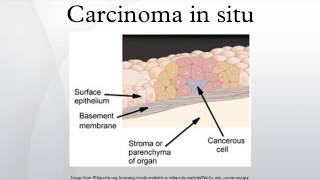 Disorders of growth and neoplasia  metaplasia dysplasia and carcinoma in situ [upl. by Nnairak172]