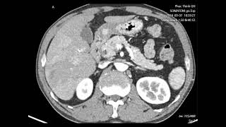 Case lâm sàng Sán lá gan  Fasciola hepatica  Dr Tùng [upl. by Trah82]