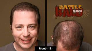 Bosley Hair Transplant Results After 12 Months Time Lapse [upl. by Docilu]