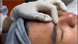 Acne treatment for Spa Linh Mun 2024 166 [upl. by Savart]