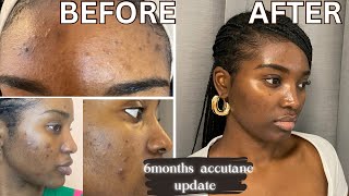 GETTING RID OF ACNE amp HYPERPIGMENTATION  6 MONTHS ACCUTANE UPDATE  ACCUTANE JOURNEY [upl. by Etnuhs]