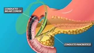CPRE COLANGIOPANCREATOGRAFÍA RETRÓGRADA ENDOSCÓPICA [upl. by Etra]
