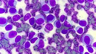 Histiocytoma cytology [upl. by Allerim]