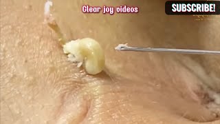 Big Cystic Acne Blackheads Extraction Blackheads amp Milia Whiteheads Removal Pimple Popping [upl. by Metabel]