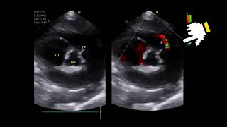 Pulmonary hypertension in an 15yearold female dog with recent syncopal episodes [upl. by Eecyaj]