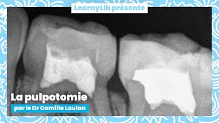 🦷 Pédodontie  les pulpotomies sur dents temporaires avec le Dr Camille LAULAN [upl. by Mij188]