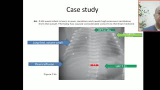 Case 123 pleural effusion pigtails drain transudate exudate chylothorax empyema [upl. by Wendy]