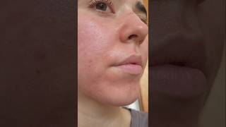 Microneedling at dermatologist first session dermatologist microneedling [upl. by Eessac]