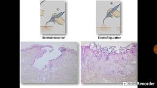 Essentials in Procedural Dermatology Part 1 Electrosurgery [upl. by Churchill]