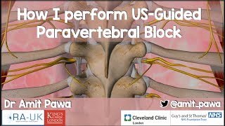 How I Perform USGuided Paravertebral Blocks [upl. by Helsie]