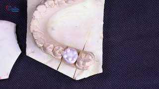 wax pattern construction for molar by Dr Ahmed Samir [upl. by Alket]