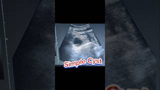 Simple Cyst  Ovary Cyst  Adnexa Cyst  haemorrhagic Cyst on Ultrasound [upl. by Meehaf]