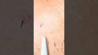 satisfying plucking relaxing tweezer [upl. by Ryun]