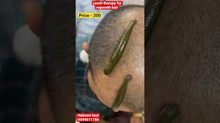 Which therapy is best for hair fall  LEECH THERAPY  leechtherapyleechkzhijamaregrowhairdrkz [upl. by Cormac822]