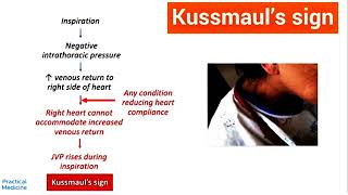 kussmaul sign شرح الباطنه [upl. by Torrance]