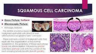 Disorders of growth and neoplasia  Malignant epithelial and mesenchymal tumors [upl. by Yellac]