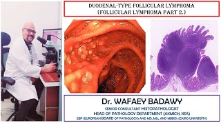 DUODENAL TYPE FOLLICULAR LYMPHOMA BY DR WAFAEY BADAWY [upl. by Nnyre]