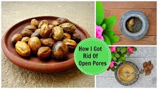 How I Got Rid Of Large OPEN PORES Permanently amp Naturally Using an Ayurvedic Remedy [upl. by Nylrehc463]