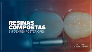 Resinas Compostas em Dentes Posteriores [upl. by Anelad]