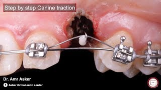 Step by step surgical exposure and orthodontic traction of impacted canine by Amr Asker [upl. by Gile]