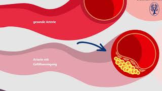 Arteriosklerose [upl. by Deering]