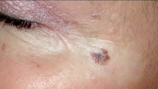 Melanoma Monday highlights the deadliest form of skin cancer [upl. by Horner539]