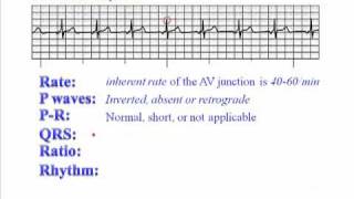 ECG Junctional Rhythm [upl. by Kathryn]