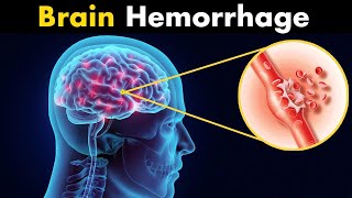 What Happens in Brain hemorrhage  Symptoms Causes and Treatment 3d animation [upl. by Akinaj]