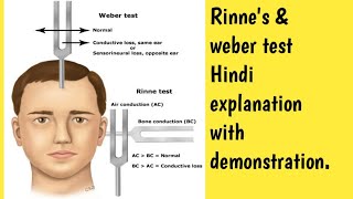 Rinne amp Weber test demonstration in Hindi explanation msn gnmcourse nursing ear [upl. by Misaq982]