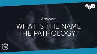 60 Seconds of Echo Teaching Answer What is the name of the pathology [upl. by Etna]