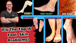 Top 15 Foot Skin Problems Toenail Fungus Dry Skin amp More [upl. by Yadnus]