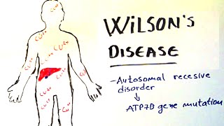 Wilsons Disease  lecture etiology clinical presentation diagnosis and treatment [upl. by Rhianna]