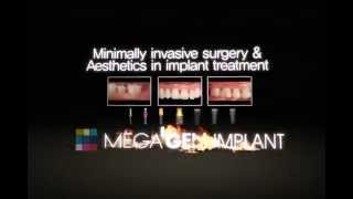 MegaGen Implant [upl. by Nire]