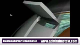 Glaucoma Surgery 3D Animation [upl. by Adolph]