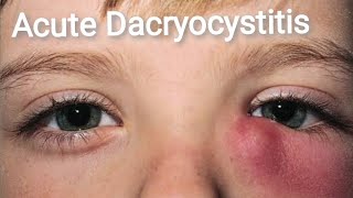 Lacrimal System  Acute and Chronic Dacryocystitis Part 2 [upl. by Kcirad]