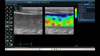 IQ 301 SPLENOMEGALY ELASTOGRAPHY ECHOPAC ANALYSIS ULTRASOUND [upl. by Carolus98]