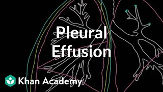 What is a pleural effusion  Respiratory system diseases  NCLEXRN  Khan Academy [upl. by Lamej581]