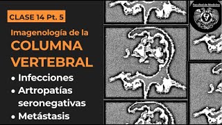 145  Imagenología en iInfecciones artropatías seronegativas y metástasis vertebrales [upl. by Ruthe]