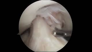 Torn Meniscus Arthroscopic Surgery [upl. by Saxela1]