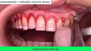 Cirurgia Periodontal osteoplastia e Osteotomia No aumento de coroa clínica [upl. by Asilad]