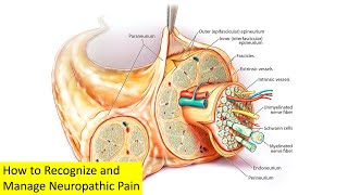 How to Recognize and Manage Neuropathic Pain [upl. by Gurl]