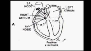 Eletrocardiografia Parte 5 de 7 [upl. by Elisee]