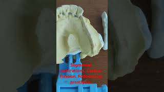 Segmental stabilization with castbar basalimplants implantdentist corticobasalimplants [upl. by Ynoffit]