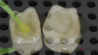 CEMENTACIÓN ZIRCONIA RELYX ULTIMATE [upl. by Rankin]