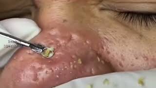 Blackhead Removal on his nose  Remove Blackhead removeblackhead [upl. by Heathcote]